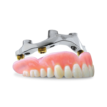 Denture Overbar